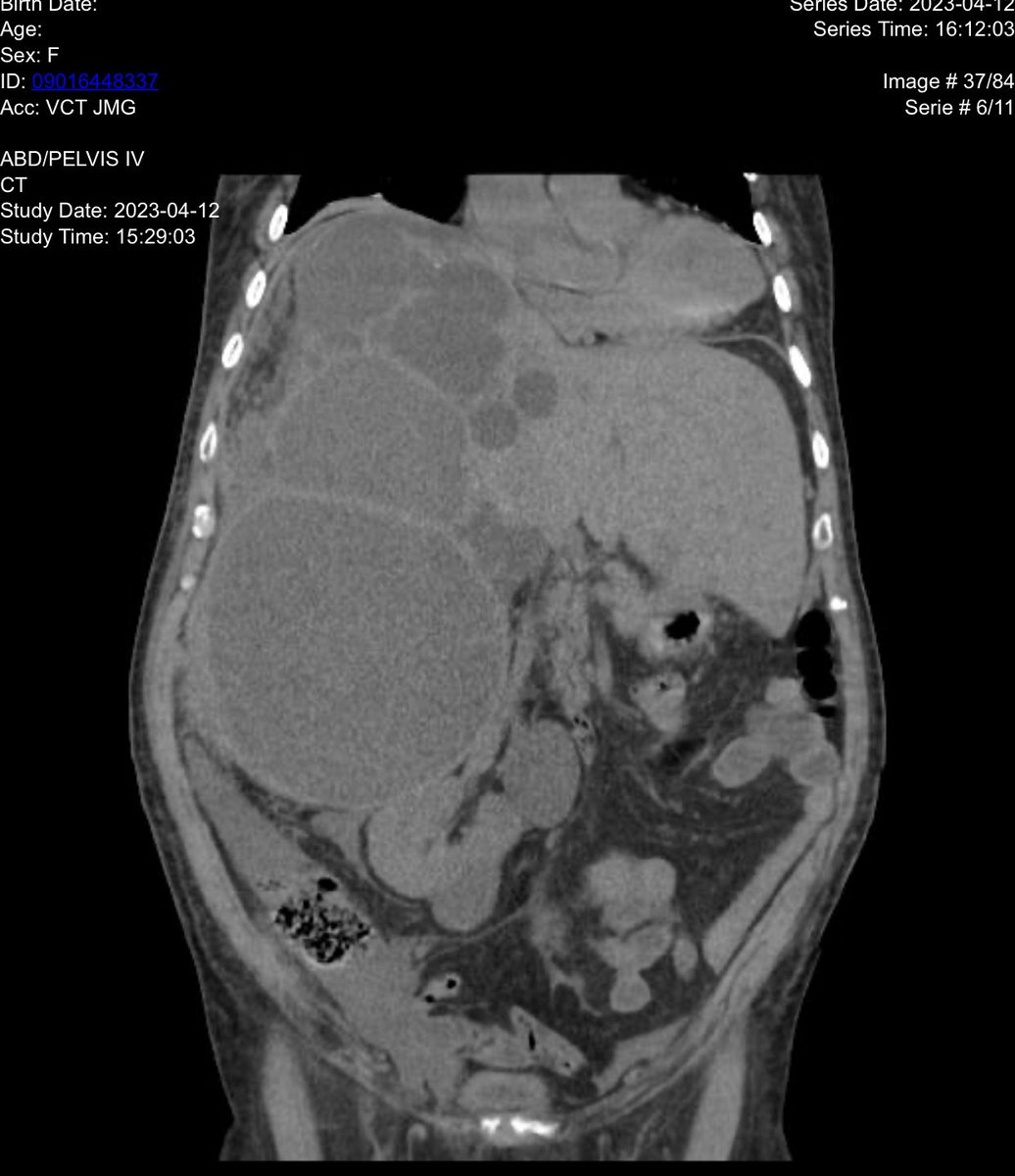 DannySilvaC1's tweet photo. La enfermedad poliquística del hígado en el adulto es una condición infrecuente y benigna, autosómica dominante, asociada con frecuencia a enfermedad poliquística renal.⁦@fncamacho96⁩ ⁦@mirellakbr⁩ ⁦@ClinicaGquil⁩ https://t.co/WPAW2KWyYR