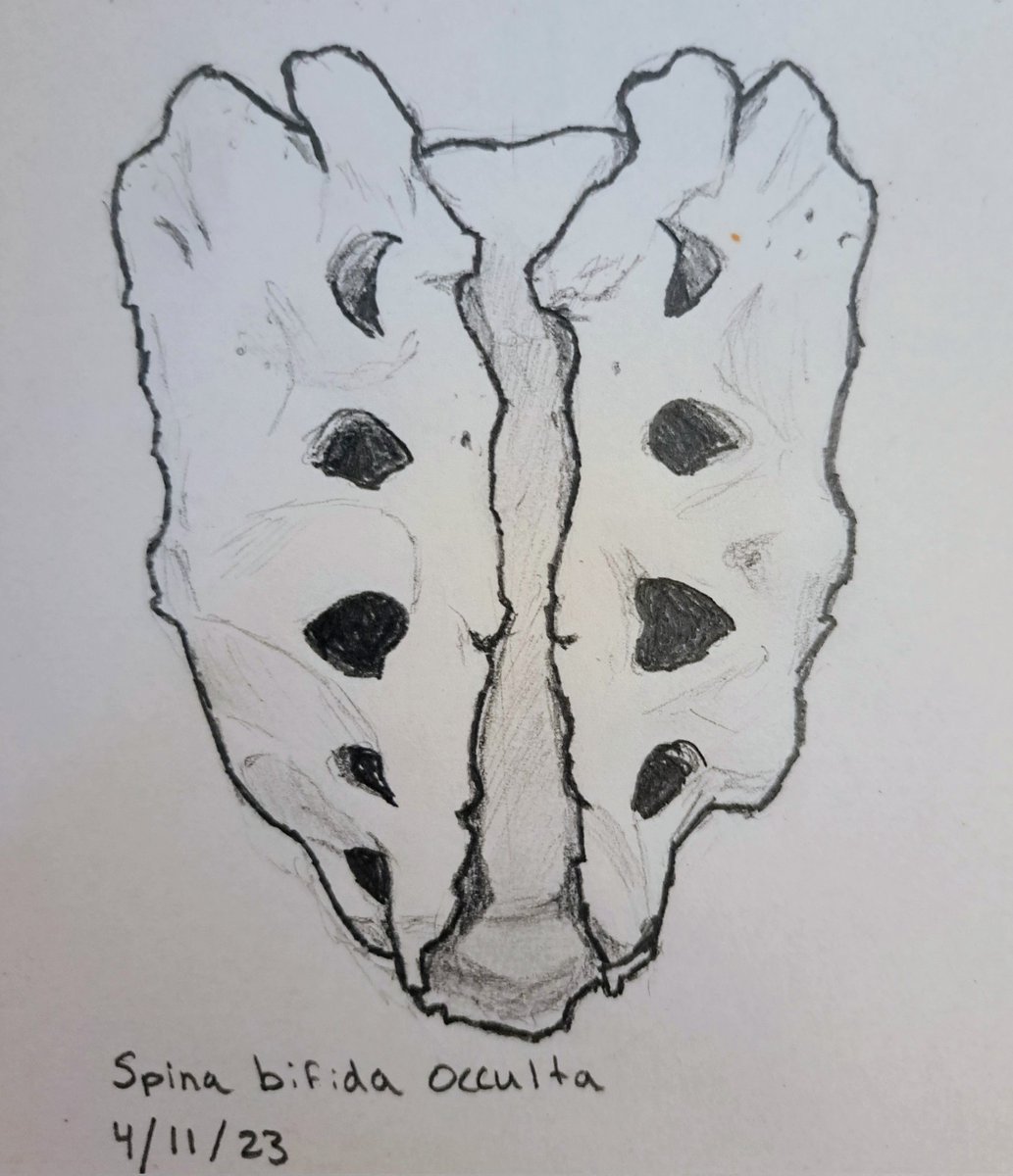KenTremblay1's tweet photo. More osteo drawings! 🦴

Spina bifida is a congenital defect associated with the failure of the neural arch to close, seen here on the sacrum. 

The occulta (hidden) variant is less severe than the cystica variant, which may include the exposure of the spinal cord. https://t.co/mKDKJcrHAD