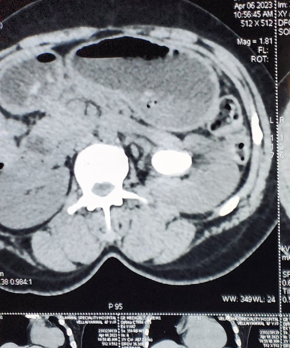 vvkejayakumar's tweet photo. Another day another stone. Yet another Successful PCNL. Removed
this huge calculus in one go. Patient is stone free now! #PCNL
#Endourologist #Urologist #maduraiurologist #KidneyStoneSurgery
#kidneystones #stonefreekidney https://t.co/mjCmSDP8LY