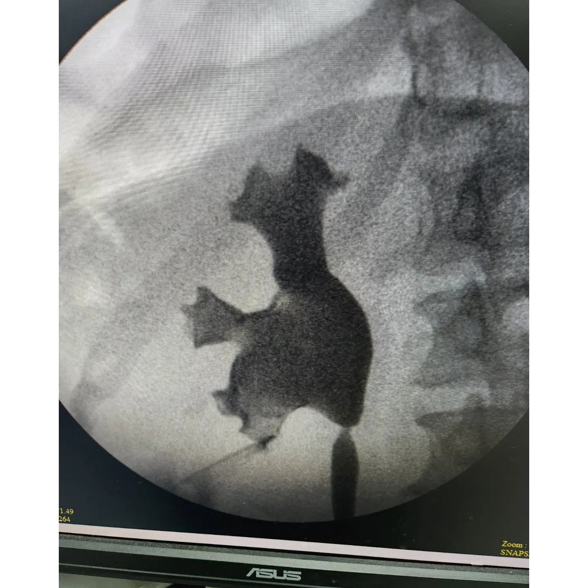 vvkejayakumar's tweet photo. Another day another stone. Yet another Successful PCNL. Removed
this huge calculus in one go. Patient is stone free now! #PCNL
#Endourologist #Urologist #maduraiurologist #KidneyStoneSurgery
#kidneystones #stonefreekidney https://t.co/mjCmSDP8LY