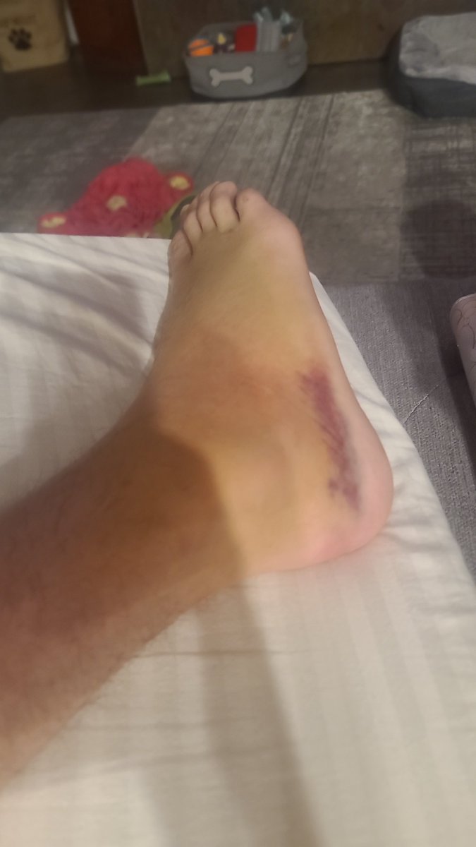 ShadowSh1fter's tweet photo. @ShanghaiSix I feel this. Had a good gym routine going, got sick, got better, started going again, AND now broke my foot 🙃 https://t.co/xS1mSJsCcz