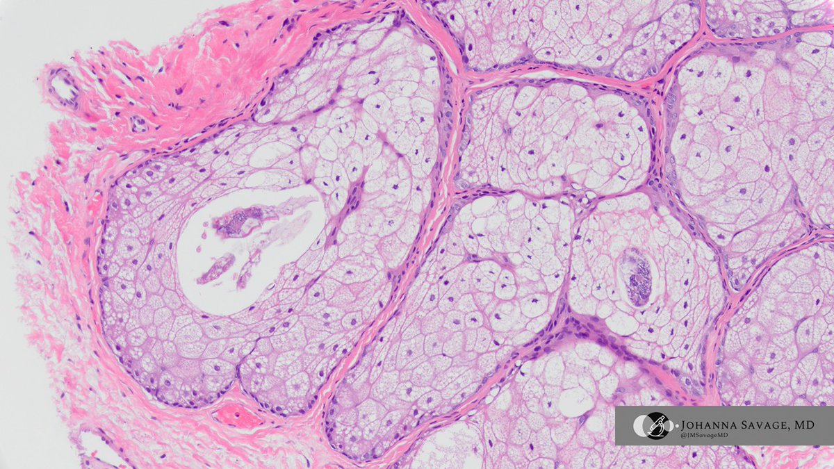 JMSavageMD's tweet image. Not all &quot;warts&quot; are warts... I spy with my little eye...

#gynpath #pathtwitter #pathbugs #vulva