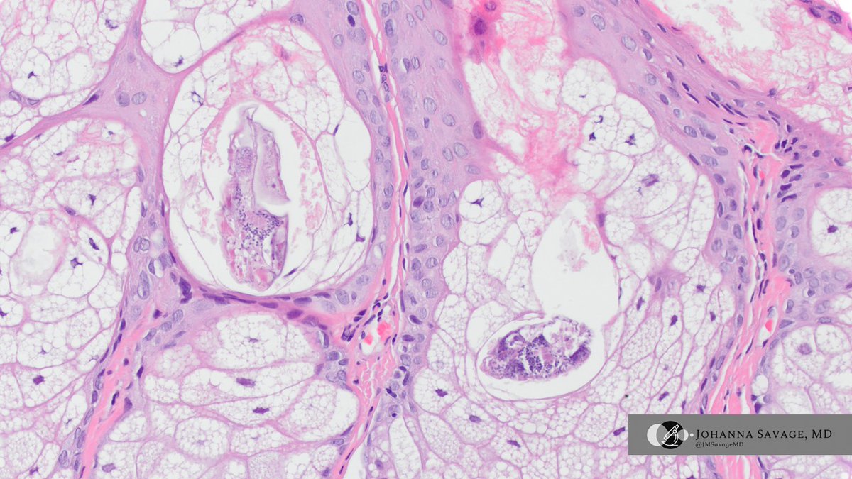 JMSavageMD's tweet image. Not all &quot;warts&quot; are warts... I spy with my little eye...

#gynpath #pathtwitter #pathbugs #vulva