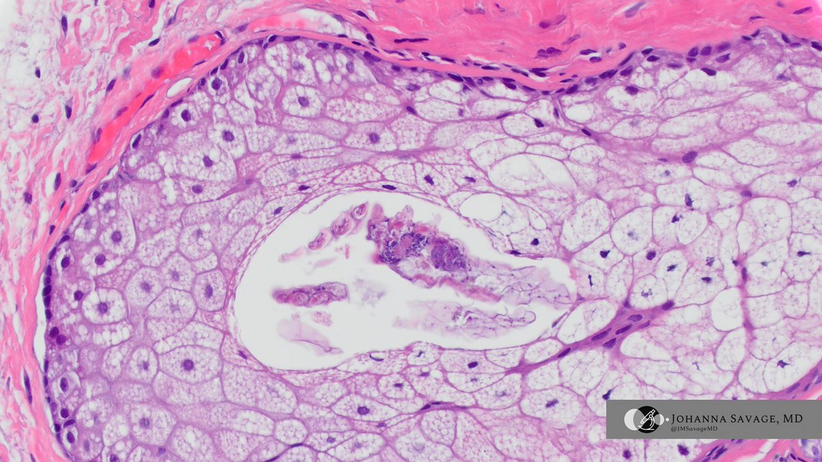 JMSavageMD's tweet image. Not all &quot;warts&quot; are warts... I spy with my little eye...

#gynpath #pathtwitter #pathbugs #vulva