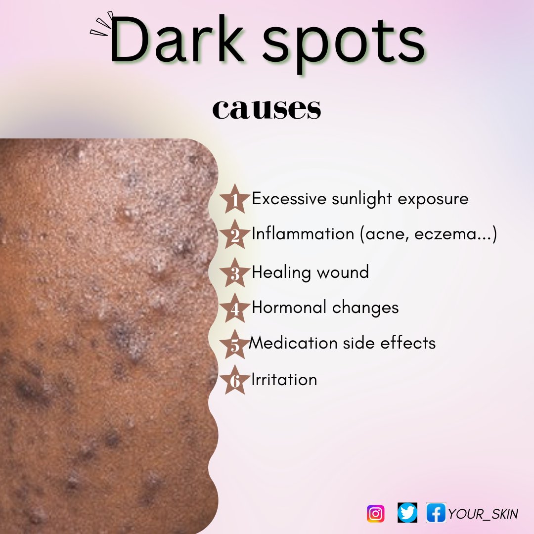 yourskin237's tweet photo. DARK SPOTS on the skin is a non serious skin  issue but sometimes very unesthetic. Avoiding causing factors helps fight DARK SPOTS. 
---
#Blemish #DarkSpots #Hyperpigmemtation #skincaretips #Beauty #Skincare   #sebum #pores #EvenSkinTone #sunlight  #GoodEveningEveryone #yourskin https://t.co/ijzoaJJtrE