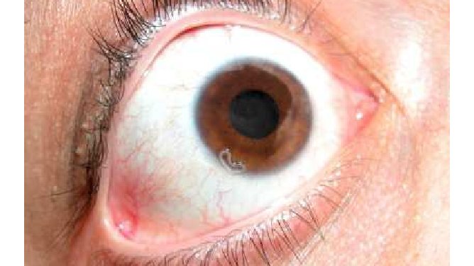 joptoophthal's tweet photo. Thelaziasis is an disease of the eye and adnexa caused by Thelazia callipaeda, a nematode parasite transmitted by drosophilid flies to humans.
#Thelaziasis #Eyedisease #ThelaziaCallipaeda #Eyeworm #Optometry https://t.co/L7z4WgwT7S