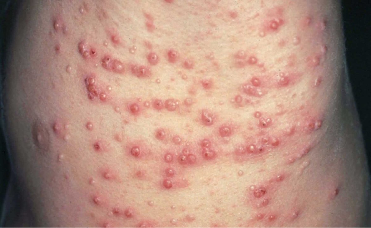 emergencyres's tweet photo. Pseudoxanthoma elasticum (PXE) is a progressive disorder that is characterized by the accumulation of deposits of calcium and other minerals (mineralization) in elastic fibers.
#PseudoxanthomaElasticum #PXE #CalciumAccumulation #InternalMedicine https://t.co/vOOq5g7ko4