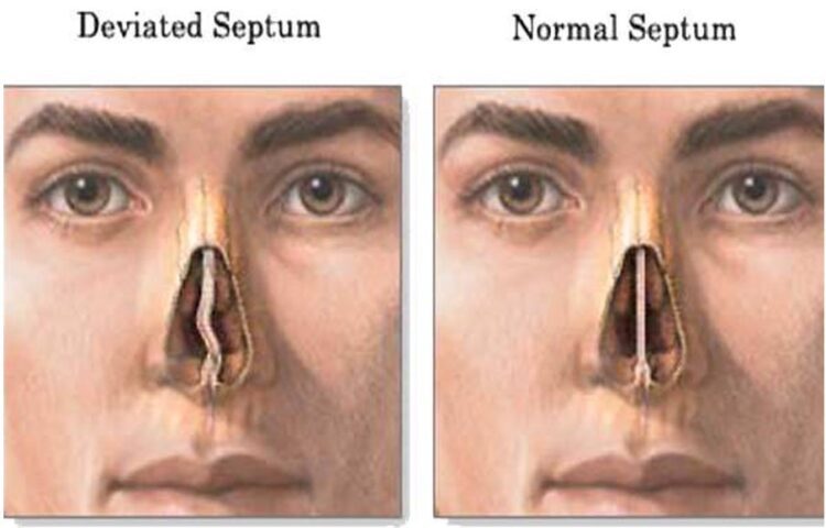 10yr old boy successfully undergoes Deviated #Septumcorrectionsurgery

Not treating sinusitis at the right time leads to #blurryvision, redness of #eyes, swelling of eyelids, recurrent #throatinfections...

healthinfive.com/10yr-old-boy-s…
