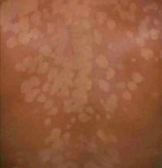 Mosesmunyi5's tweet photo. LET'S TALK ABOUT SKIN INFECTIONS 

1. TINEA VERSICOLOR 
It's caused by a fungus on the skin that grows out of control.
not painful and It doesn't spread from person to person.
CAUSES OF TINEA VERSICOLOR 
1. Hormonal changes 
2. Oily skin
4. Weakened immune system
TREATMENT 👇 https://t.co/xOmfSF2PYo