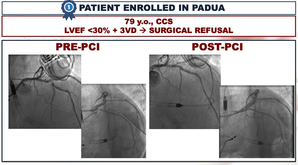 📣PROTECT-EU study 🇮🇹🇩🇪 🥇First patient enrolled in Padua! 🎯CCS, 3VD, EF<30% Surgical refusal HRPCI+preventive strategy! #IMPELLACP @alaide_chief @BURZOTTA_F @CristinaAuri17 @giuliamasiero3 @saia_francesco @espogiov @sicigise @DrLucaTesta @AGIKinterv @MoritzSeiffert