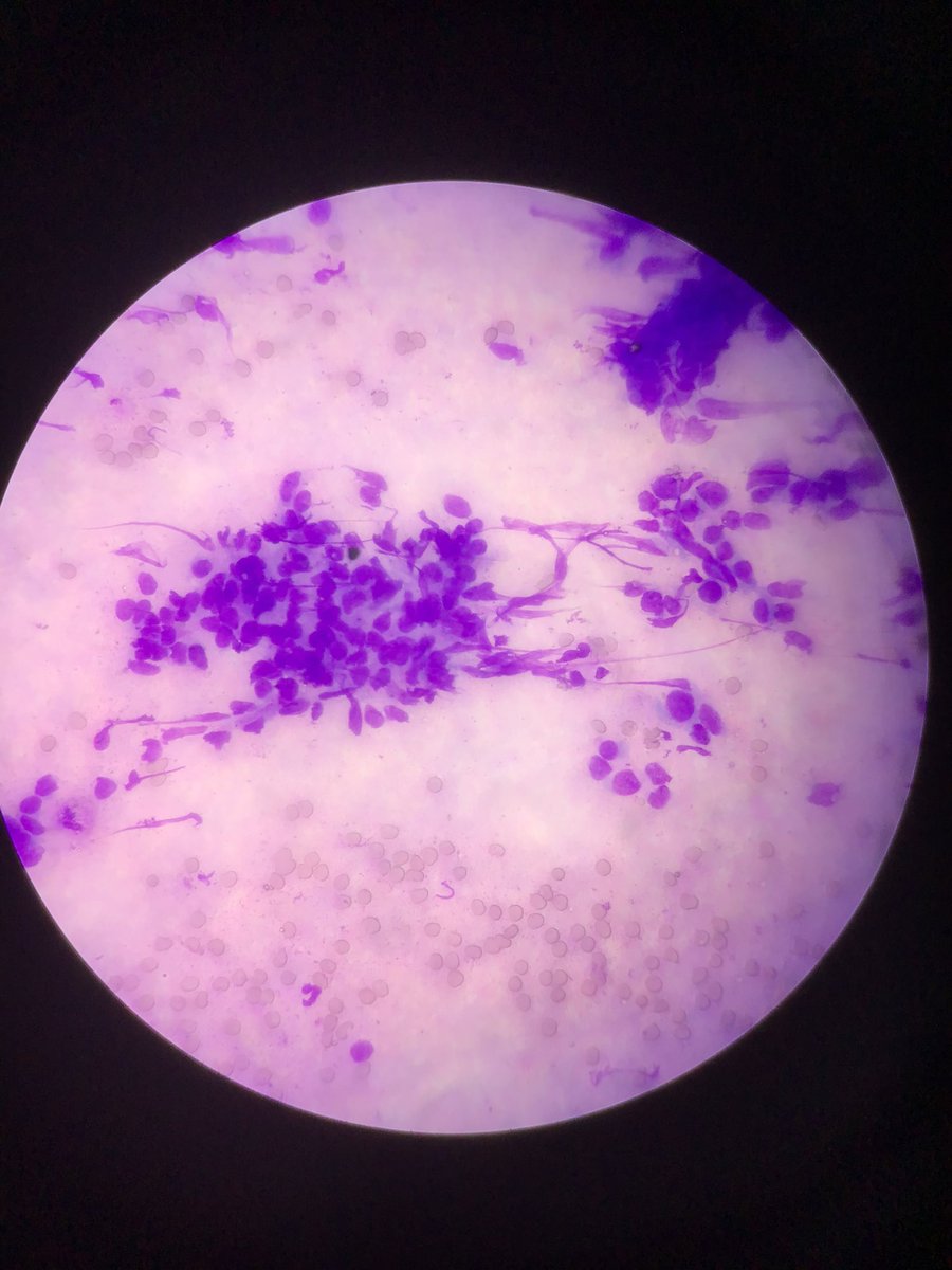 DrPrernaPath's tweet photo. Mass on perithyyoid region 3x3 cms of 63 years male. What can be the diagnosis.
#cytopath #cytology #pathology #cytology #fnac https://t.co/B63UyqF7zo