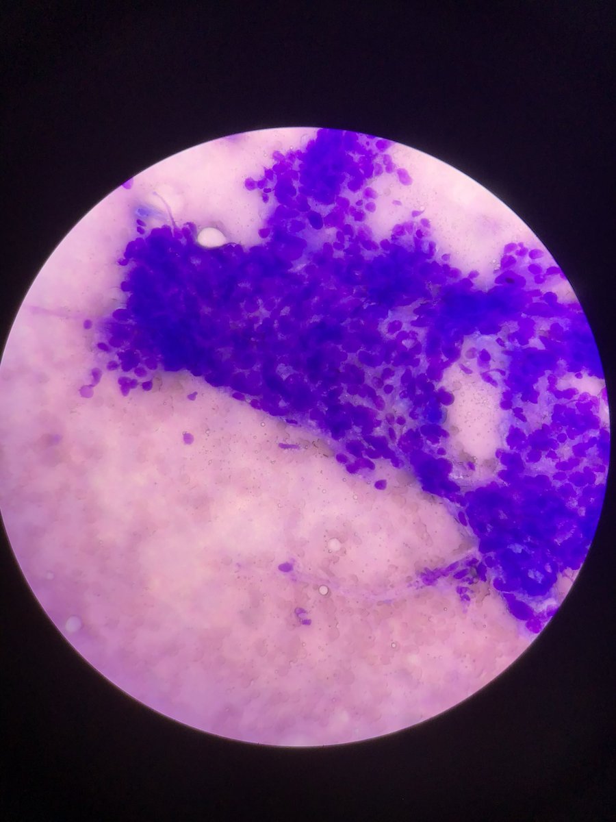 DrPrernaPath's tweet photo. Mass on perithyyoid region 3x3 cms of 63 years male. What can be the diagnosis.
#cytopath #cytology #pathology #cytology #fnac https://t.co/B63UyqF7zo