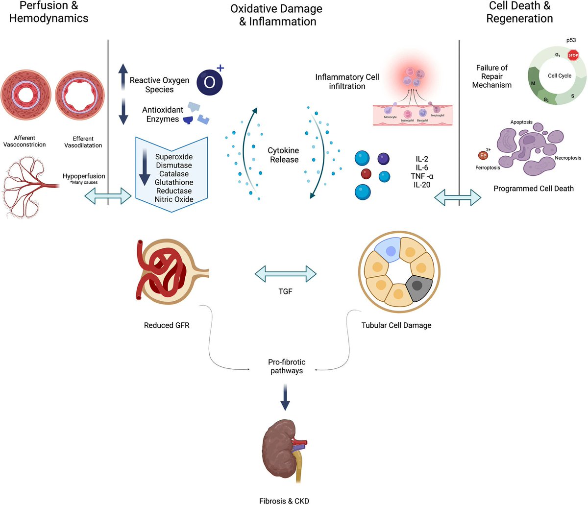 Ped_Neph's tweet photo. AKI is complex &amp; affects a significant proportion of hospitalized children. The breadth &amp; impact of AKI in adults &amp; children have come to the fore recently. Read this Review of novel &amp; repurposed therapeutic agents; proposed mechanisms of action; &amp; more.
https://t.co/jf3nuzho8w https://t.co/PdZKJ9GE1w