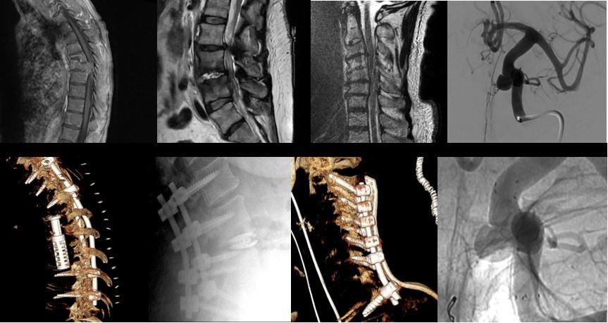 Rizwan Tahir (@riztahirmd) on Twitter photo Heavy Metal Week <a href="/MedStarWHC/">MedStar Washington</a>. 3-level thoracic corpectomy, Lumbar TLIF, Posterior Cervical with @NuVasiveInc. Superior Hypophyseal Aneurysm Fred X with @MV_Terumo. With <a href="/tianzanzhou/">Tianzan "Taz" Zhou</a> <a href="/jeffreybretonMD/">Jeffrey Breton, MD</a> <a href="/MGUHNeurosurg/">Georgetown/WHC Neurosurgery</a>. #neurosurgery #spine #aneurysm #medicine #Ramadan Heavy Metal Week <a href="/MedStarWHC/">MedStar Washington</a>. 3-level thoracic corpectomy, Lumbar TLIF, Posterior Cervical with @NuVasiveInc. Superior Hypophyseal Aneurysm Fred X with @MV_Terumo. With <a href="/tianzanzhou/">Tianzan "Taz" Zhou</a> <a href="/jeffreybretonMD/">Jeffrey Breton, MD</a> <a href="/MGUHNeurosurg/">Georgetown/WHC Neurosurgery</a>. #neurosurgery #spine #aneurysm #medicine #Ramadan