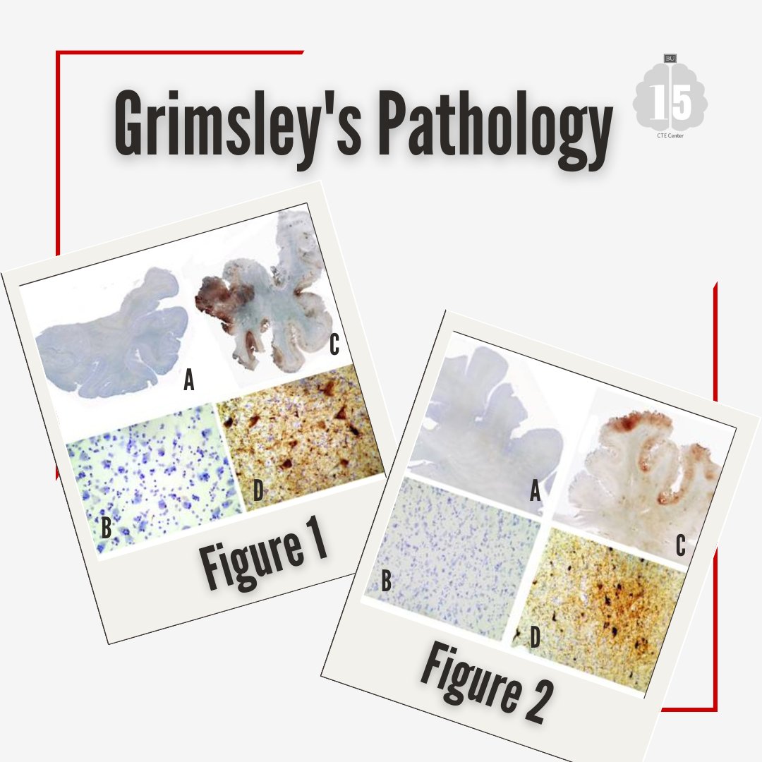 bu_cte's tweet photo. As we finish the first week of our #Flashback15 series, learn more about former NFL player John Grimsley's CTE diagnosis. We thank the Grimsley family for their generous donation and contribution to our research. (1/2) https://t.co/PSR5TjL6gs
