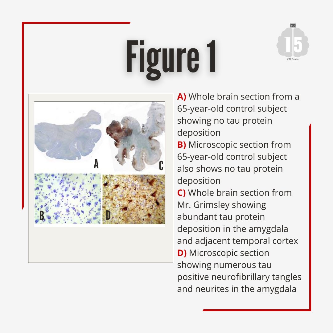 bu_cte's tweet photo. As we finish the first week of our #Flashback15 series, learn more about former NFL player John Grimsley's CTE diagnosis. We thank the Grimsley family for their generous donation and contribution to our research. (1/2) https://t.co/PSR5TjL6gs