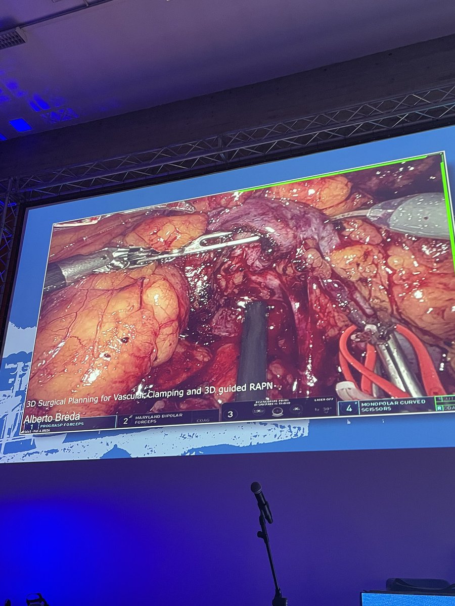 #Metaverse planning before partial nephrectomy of very complex mass. Preoperative planning surely represent a crucial moment for every surgery, never skip it! What a surgery, thank you @AlbertoBreda1 for this masterclass during #TUM23! @PorpigliaF @danieleamparore