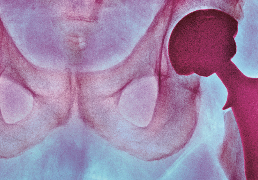 hug_ge's tweet photo. Pour accompagner au mieux les personnes avec une indication de prothèse totale de hanche, une brochure détaillée est désormais utilisée en consultation préopératoire #prothèse #hanche #arthroplastie https://t.co/FiHyvnZMSl https://t.co/4NF4psaHDX