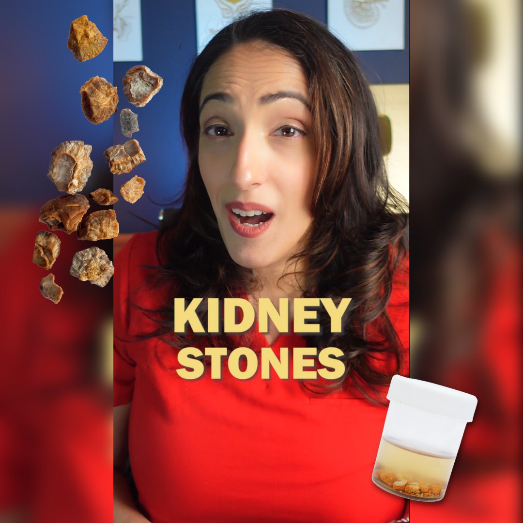 Are men more prone to #kidneystones? Find out here: instagram.com/reel/CqS3b0NBz…

#kidneyfacts #healthykidneys #kidneyhealth #urology #renamalikmd