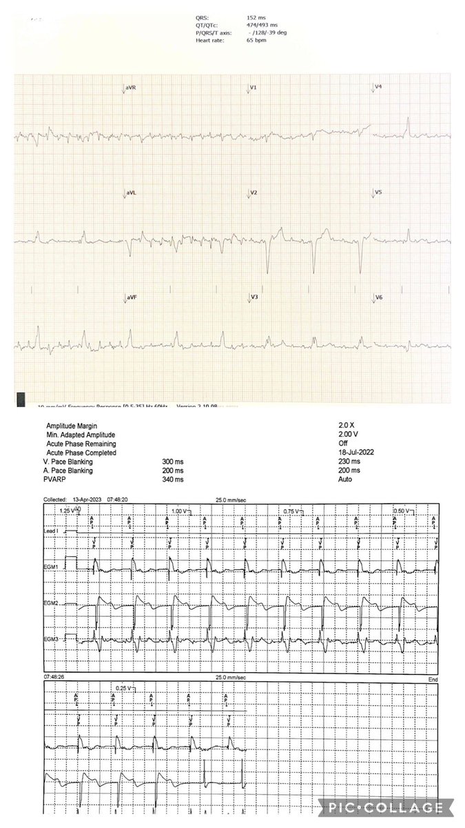 Samantha Sublette MD (@flutter_md) on Twitter photo An example of Parkinson tremor on ECG and the corresponding pacemaker check showing an atrial paced rhythm <a href="/NCHRooneyHeart/">NCH Rooney Heart Institute</a> #EPeeps #CardioEd #cardiofellows <a href="/lauramullerMD/">Laura Muller</a> <a href="/Waeldakkak88/">Wael Dakkak, MD</a> <a href="/Dhiran_Verghese/">Dhiran Verghese</a> An example of Parkinson tremor on ECG and the corresponding pacemaker check showing an atrial paced rhythm <a href="/NCHRooneyHeart/">NCH Rooney Heart Institute</a> #EPeeps #CardioEd #cardiofellows <a href="/lauramullerMD/">Laura Muller</a> <a href="/Waeldakkak88/">Wael Dakkak, MD</a> <a href="/Dhiran_Verghese/">Dhiran Verghese</a>