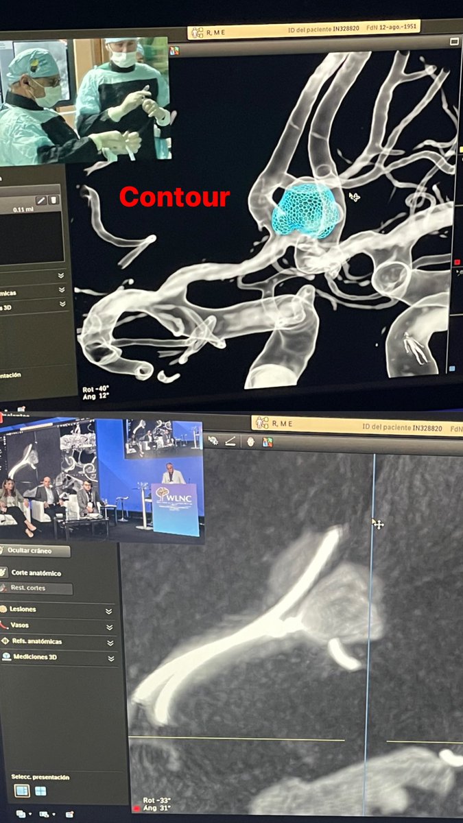 Wonderful cases (<a href="/CereVasc/">CereVasc</a> &amp; <a href="/IncCerus/">Cerus Endovascular</a>) from <a href="/eneri_neuro/">ENERI - Dr. Pedro Lylyk</a> @ENERI_BSAS @SAGRADA_BSAS  supporting the huge and growing endovascular armamentarium in the neurovascular scenario and beyond…! <a href="/cvsection/">CV Section</a> #WLNC2023 <a href="/WLNCofficial/">WLNC2026| 22-24 2026 - Lisbon/Portugal</a>