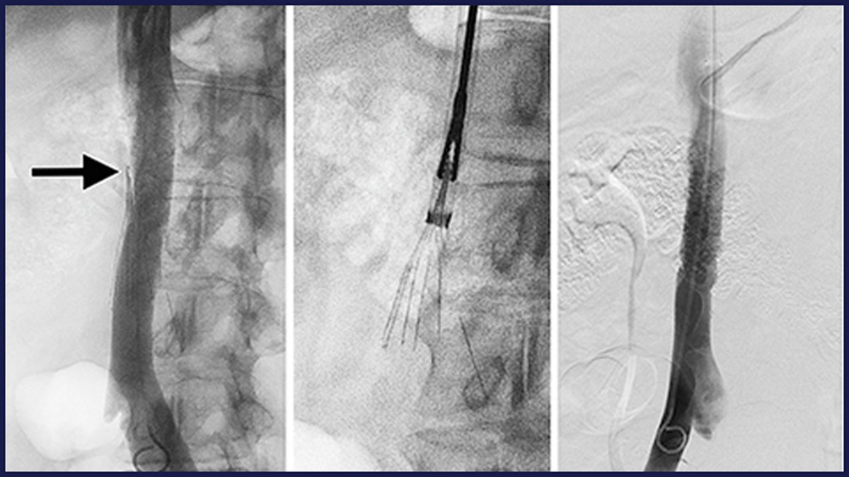 JVIRmedia's tweet photo. Endobronchial Forceps Retrieval of Embedded Inferior Vena Cava Filters: Retrieval of 535 Filters at a Single Center

@swstav @pennir

https://t.co/pMleUYHTiU https://t.co/ssJmYsSCEK