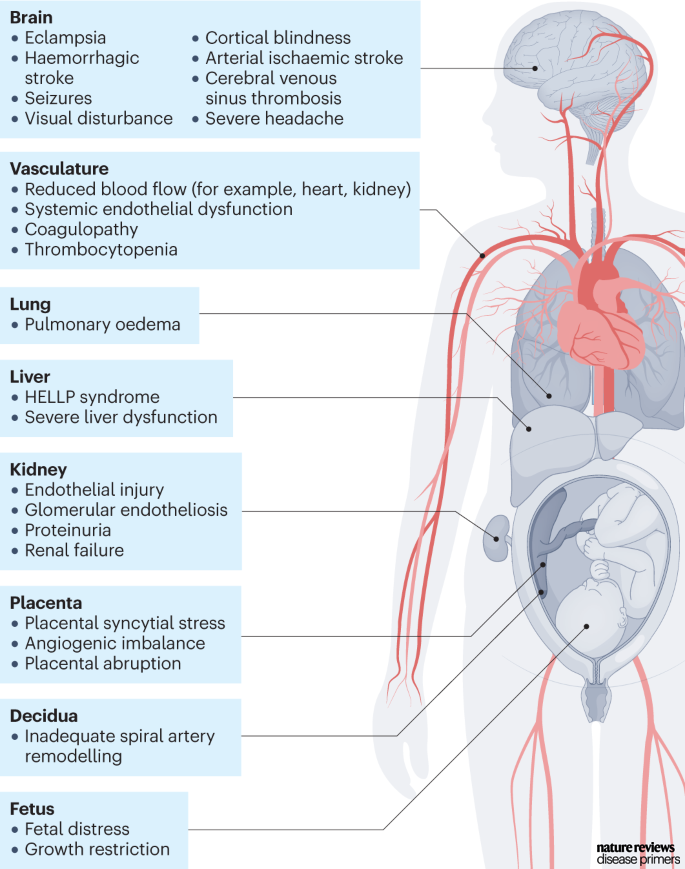 DiseasePrimers's tweet photo. #Preeclampsia is defined as new onset hypertension >20 weeks of gestation in a previously normotensive patient plus one other symptom of maternal organ dysfunction. It affects the foetus and multiple maternal tissues. https://t.co/GNf2sJpov4 https://t.co/MC8Le10zfv