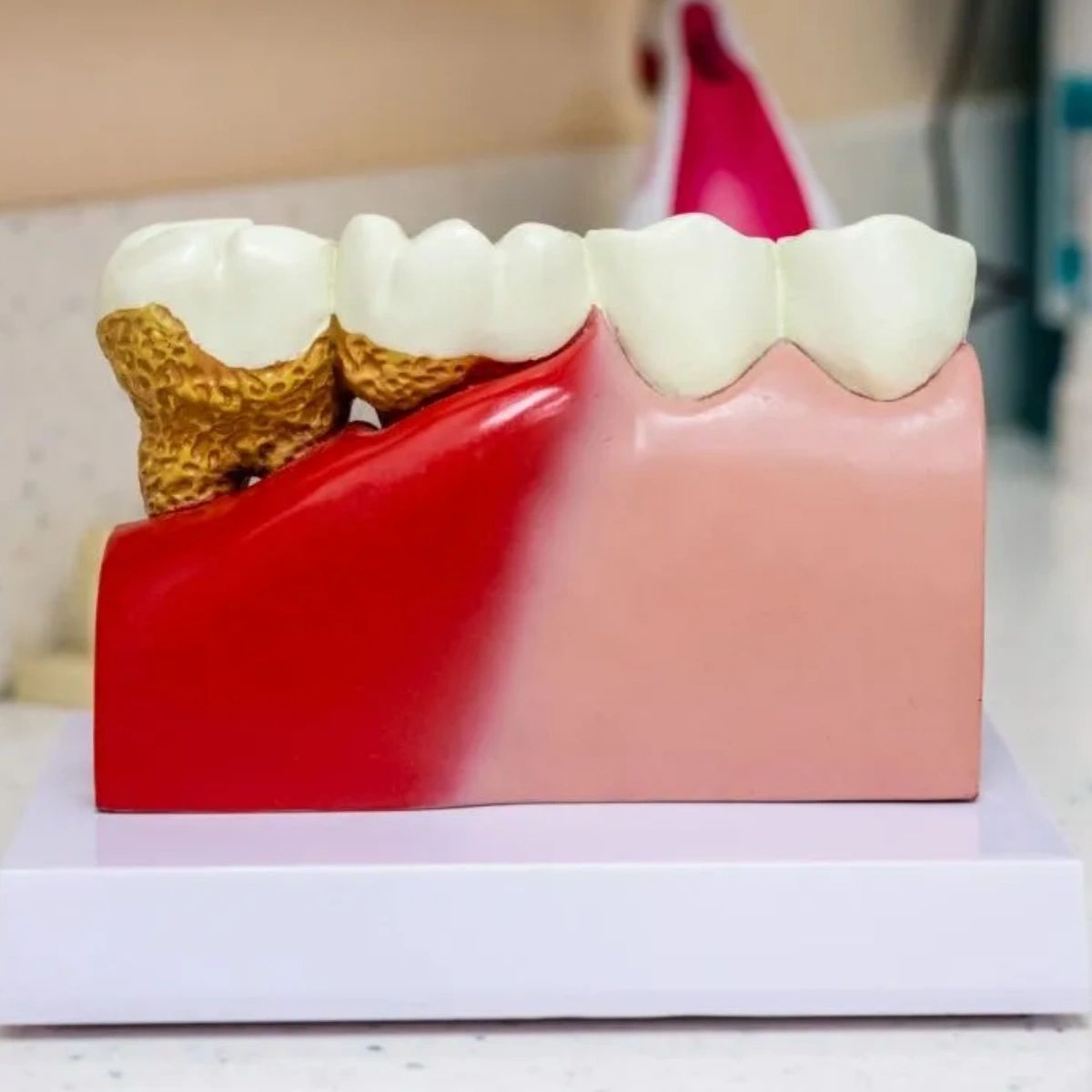 Root canal treatment is designed to eliminate bacteria from the infected root canal, prevent reinfection of the tooth, and save the natural tooth. If you experience severe pain while chewing or biting or lingering sensitivity to hot or cold, you may need a root canal.