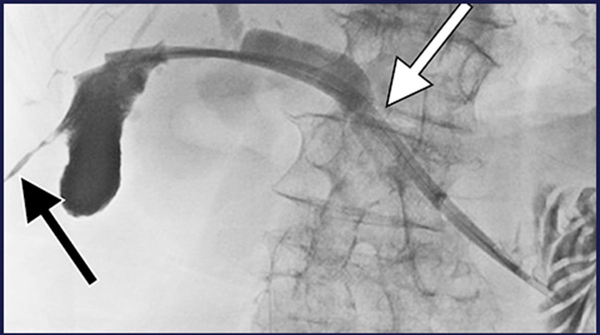 Percutaneous Cystic Duct Interventions and Drain Internalization for Calculous Cholecystitis in Patients Ineligible for Surgery

<a href="/AhsunR/">Ahsun Riaz</a> <a href="/NorthwesternIR/">NorthwesternIR</a> <a href="/riadsalemIR/">Riad Salem</a> 

ow.ly/v3Z850NumiO