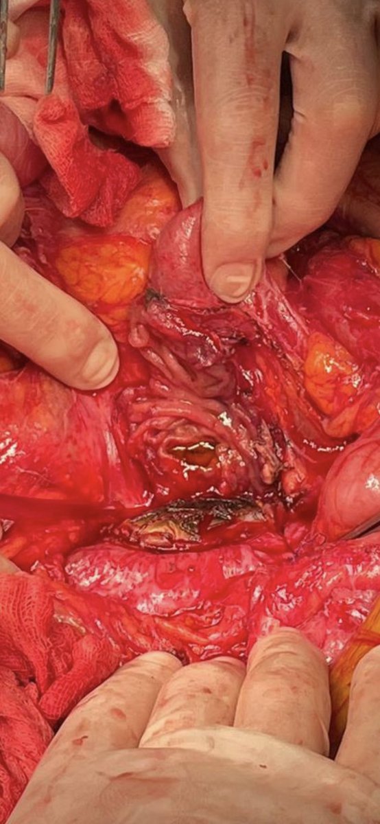 Partial dacron explantation + aortouniiliac EVAR + fem-fem for aortoenteric fistula?

 …perhaps not a good idea.

Recurrence after 2 years. 

Explantation of residual Dacron & endograft +Aortic closure + duodenum repair + axilo fem. #aortaEd #SoMe4Surgery #EVAR #vascsurg