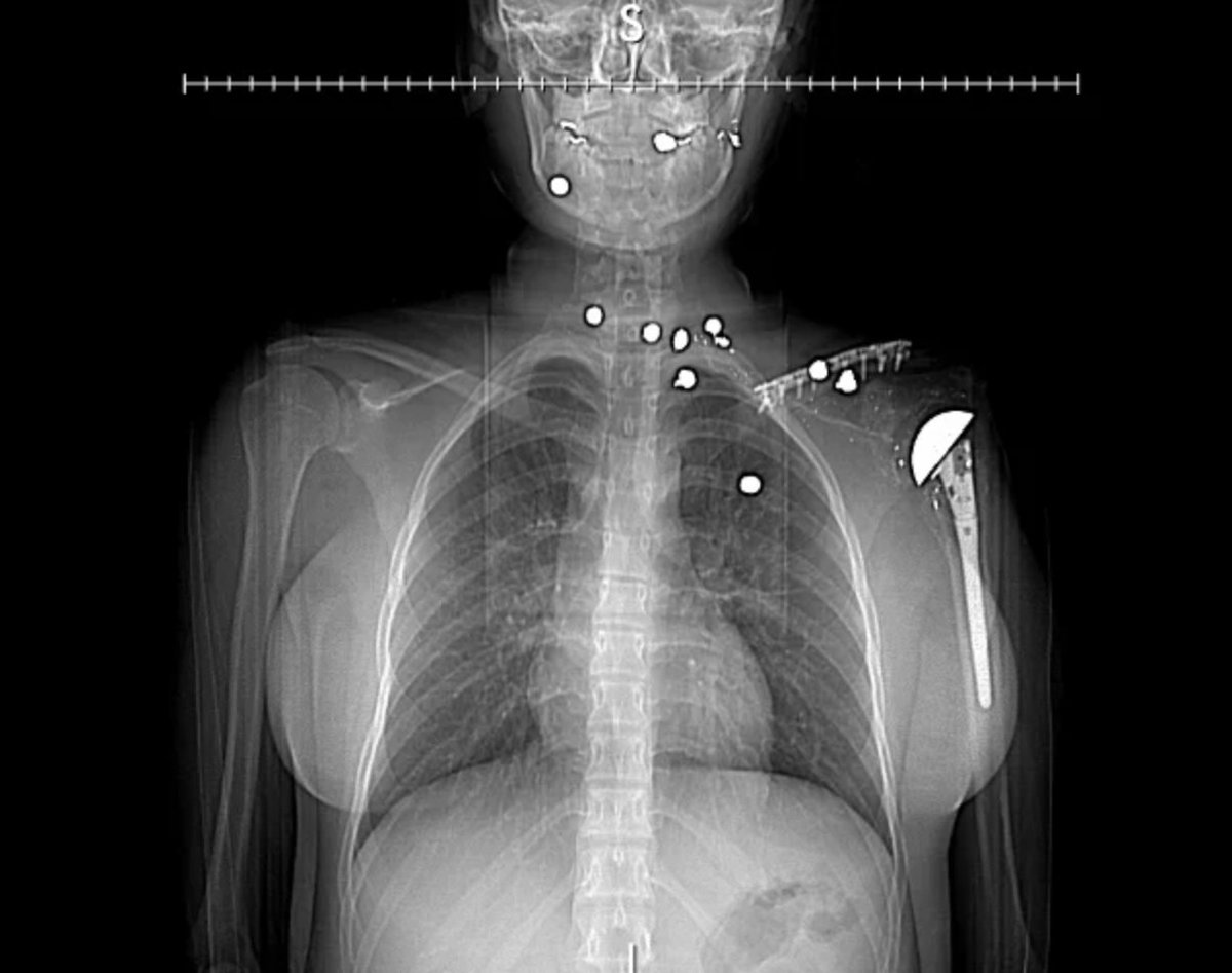 Tonight’s #GreysAnatomy lead poisoning medical case was inspired by the true stories of shooting survivors suffering from lead poisoning from bullets left in their bodies. 

Learn more: tinyurl.com/2en9c8y2