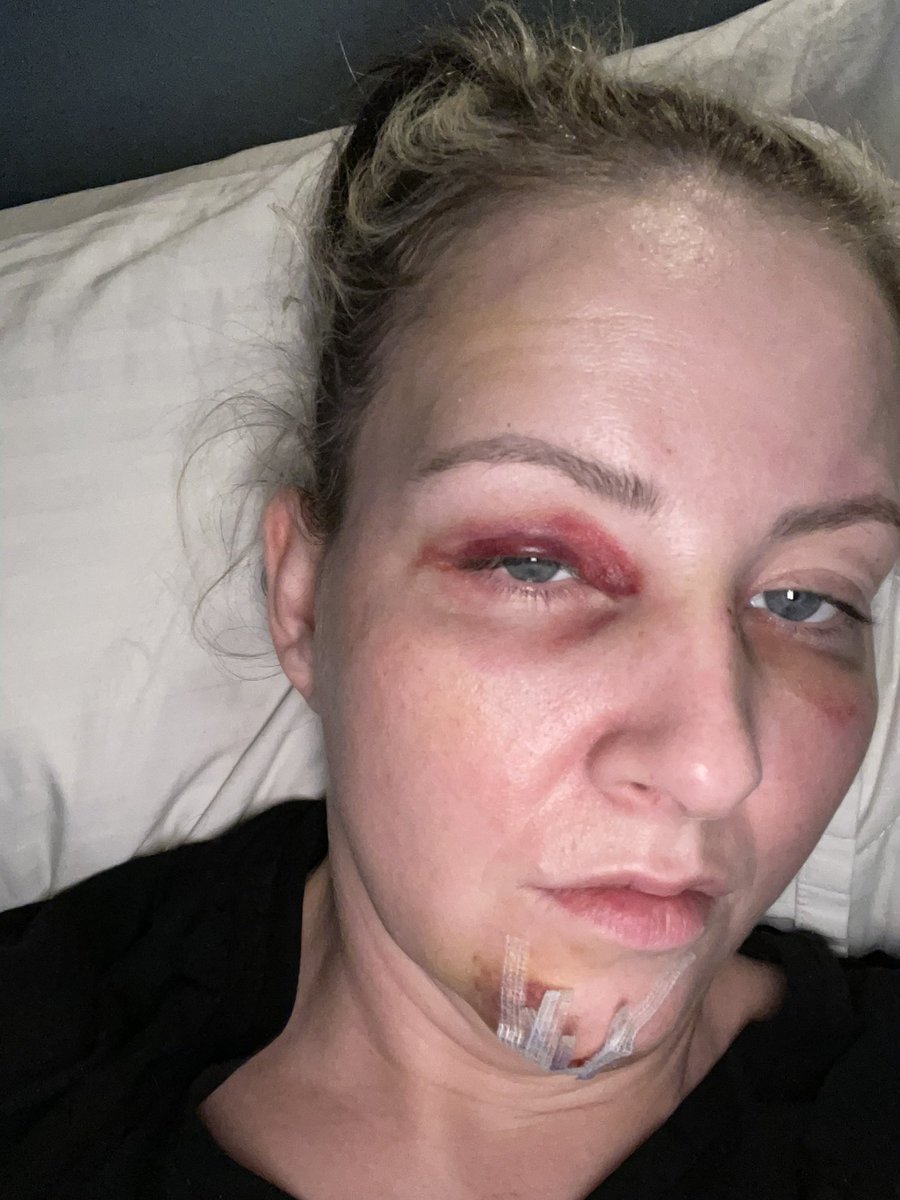 Lenti á vegg (og gólfi) og eftir þrjá daga á slysó er greiningin: Örmögnun/ kulnun þarf að læra að slaka á.
Mastersritgerð skrifuð af mér sjálfri: kulnun í starfi 👀