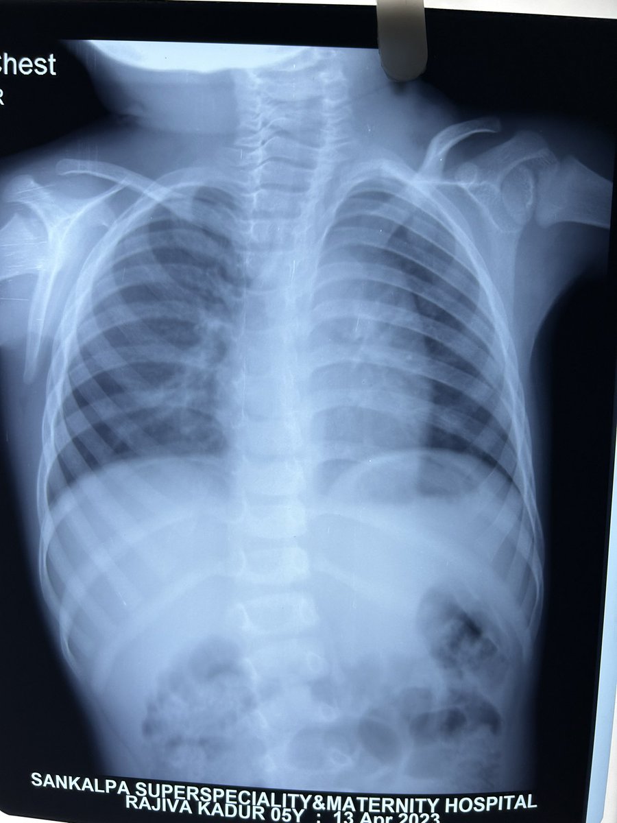 4 Yr boy with H/o low weight gain according to age referred for echo . ESM all over precordium . ECG and Chest X-ray taken .@DrRajeshG1 @escardio @ACCinTouch