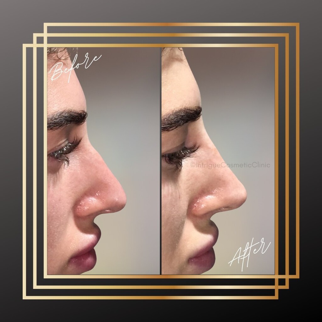 We placed a little filler to the bridge of the nose just above the bump to create a beautifully straight profile, and added to the tip to give a tip lift for this lovely returning client.
An instant nose job without the need for invasive surgery or lengt… instagr.am/p/Cq_KLXEoZX0/