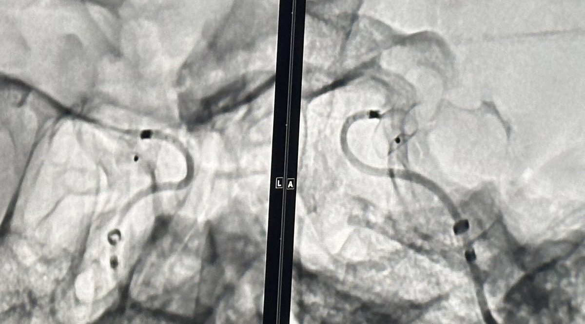 Daniel M. Heiferman, MD (@danheifermanmd) on Twitter photo <a href="/johannatfifi/">Johanna T. Fifi, MD</a> 🇺🇸 presents her use of the Bendit 021 microcatheter for deployment of a WEB in a sidewall aneurysm
Amazing how stable the microcatheter was during WEB tracking, particularly with that 180 degree turn
<a href="/WLNCofficial/">WLNC2026| 22-24 2026 - Lisbon/Portugal</a> #WLNC2023 @MV_Terumo <a href="/johannatfifi/">Johanna T. Fifi, MD</a> 🇺🇸 presents her use of the Bendit 021 microcatheter for deployment of a WEB in a sidewall aneurysm
Amazing how stable the microcatheter was during WEB tracking, particularly with that 180 degree turn
<a href="/WLNCofficial/">WLNC2026| 22-24 2026 - Lisbon/Portugal</a> #WLNC2023 @MV_Terumo
