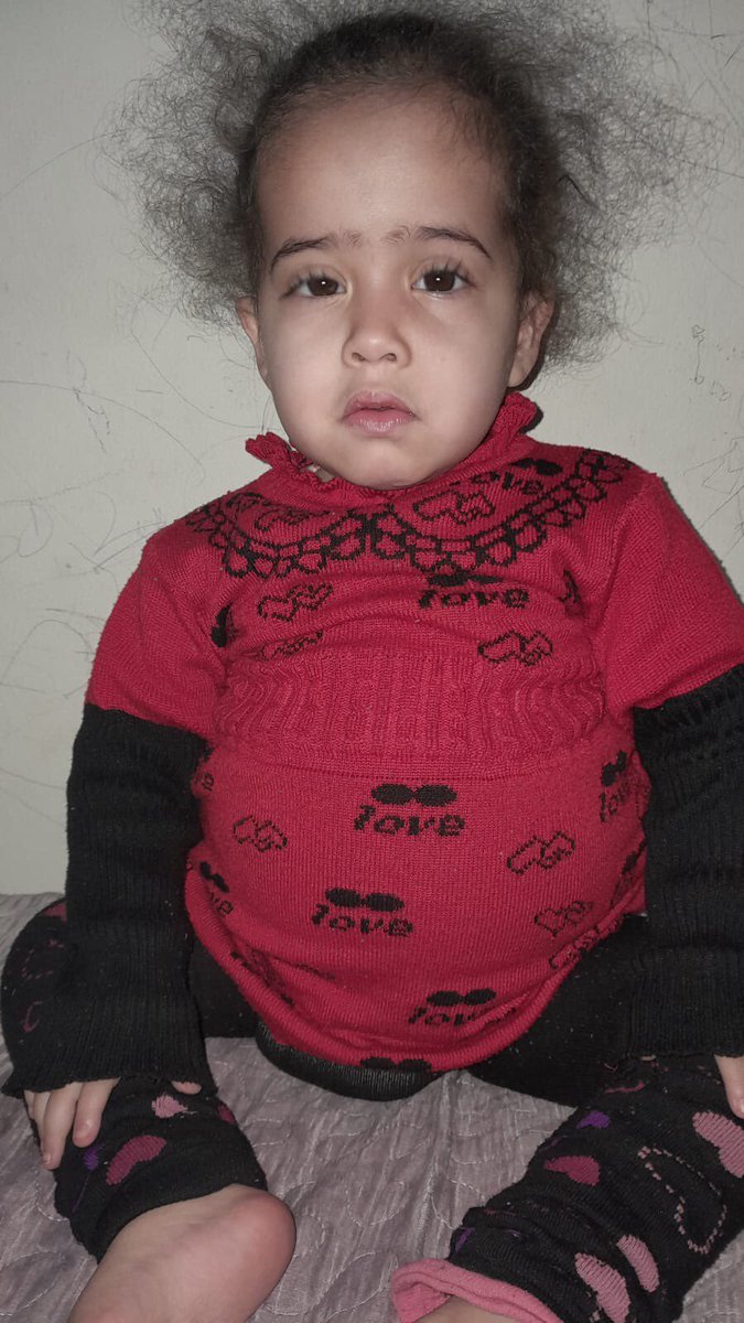 Huda00832899's tweet photo. Look at their pale little faces. Lana and Sohayb, suffers from the rare Fanconi Bieckle disease complications, such as Osteomalacia, phosphorus deficiency, splenomegaly, Hepatomegaly, and Asthma.they needs high medical expenses and special Milk, donate now
https://t.co/OmwfH0gSlO https://t.co/3r9X0Kmm1L