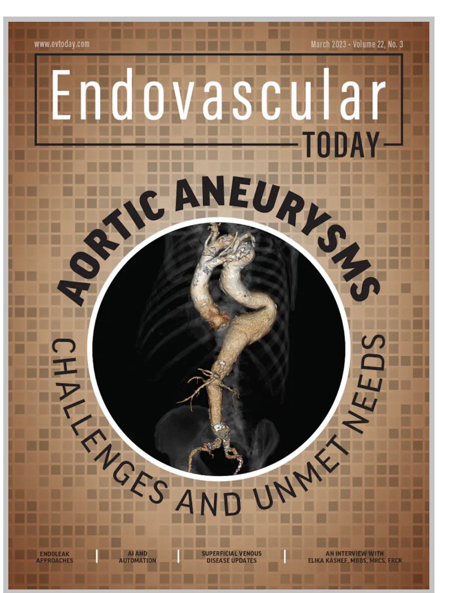 UW Vascular (@uwvascsurg) on Twitter photo What are the current unmet needs in Thoracoabdominal aortic repair? Dr Zettervall: access to off-the-shelf devices and the resulting disparities of care. Learn more: evtoday.com/articles/2023-… <a href="/SZettervallMD/">Sara Zettervall</a> <a href="/EVToday/">Endovascular Today</a> What are the current unmet needs in Thoracoabdominal aortic repair? Dr Zettervall: access to off-the-shelf devices and the resulting disparities of care. Learn more: evtoday.com/articles/2023-… <a href="/SZettervallMD/">Sara Zettervall</a> <a href="/EVToday/">Endovascular Today</a>
