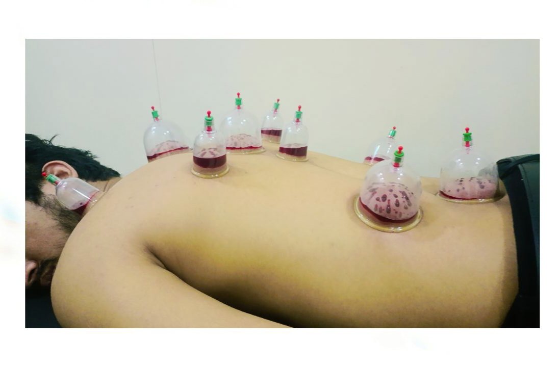 new_cupping's tweet photo. Cupping Therapy is the best way of treatment and medicine https://t.co/IEGkpJyCXp