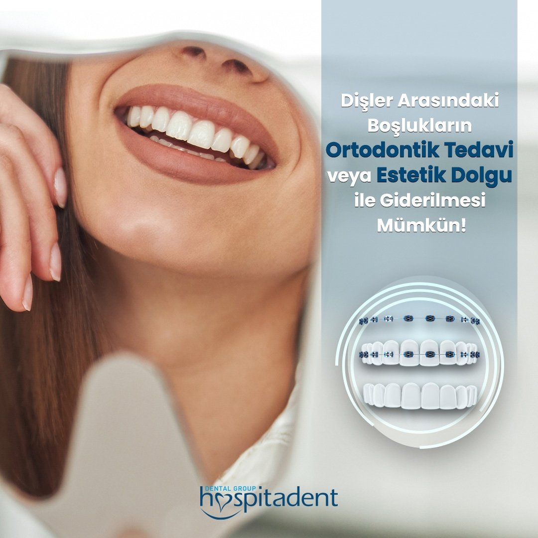 Hospitadent's tweet photo. Ön dişlerin arasındaki boşlukları hiç problem olarak görmeyebilirsiniz. Ancak düzeltilmesini istiyorsanız, dişleri birbirine yaklaştırmak için ortodontik tedavi veya estetik dolgu gibi kozmetik çözümler bulunmaktadır. https://t.co/PIPUo4XrJf