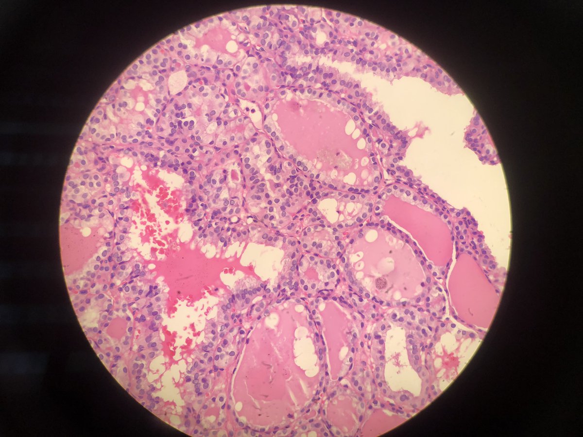glinglerimek's tweet photo. Macrofollicular subtype PTC #cytolovers #cytohistopath https://t.co/FNZPvnI2uG