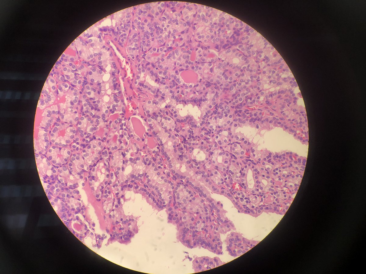 glinglerimek's tweet photo. Macrofollicular subtype PTC #cytolovers #cytohistopath https://t.co/FNZPvnI2uG