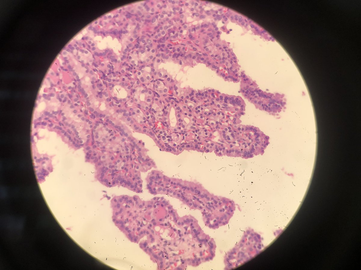 glinglerimek's tweet photo. Macrofollicular subtype PTC #cytolovers #cytohistopath https://t.co/FNZPvnI2uG