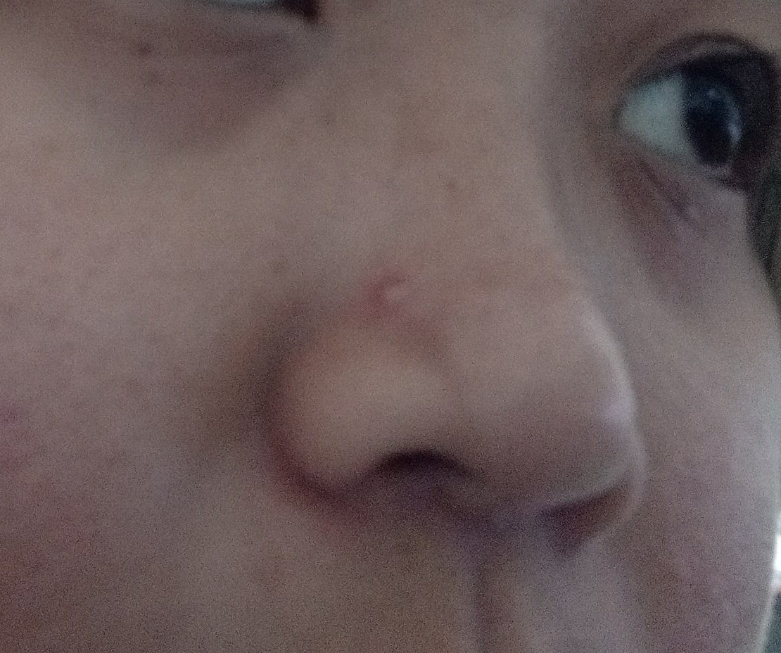 Jerawat kayak bekas tindik 🤣 btw, ada saran ga buat ngehempasin jerawat gede gini?? Ga mau mencetin ntar bopeng hahahaha