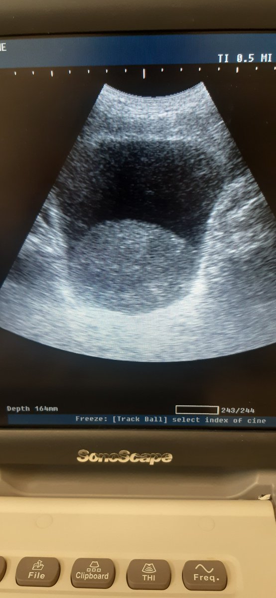 My first post Holep Bleeding
MI primer sangrado post HOLEP.