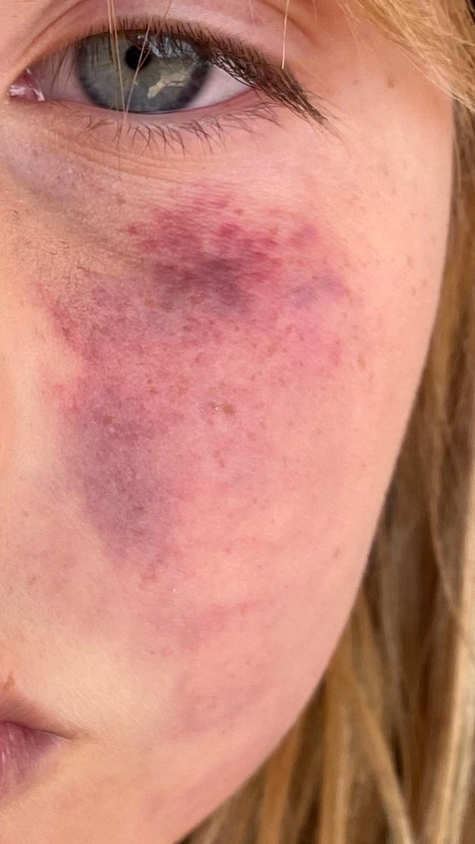 Shers_Sparks's tweet photo. @DiaryOfABlueDot @Cabal_Educator Payne County loves abusers. This girl &amp; her sister were adopted by a non relative who fought their family &amp; won b4 this happened at the 6 month mark. https://t.co/kXO0ZrIqOA