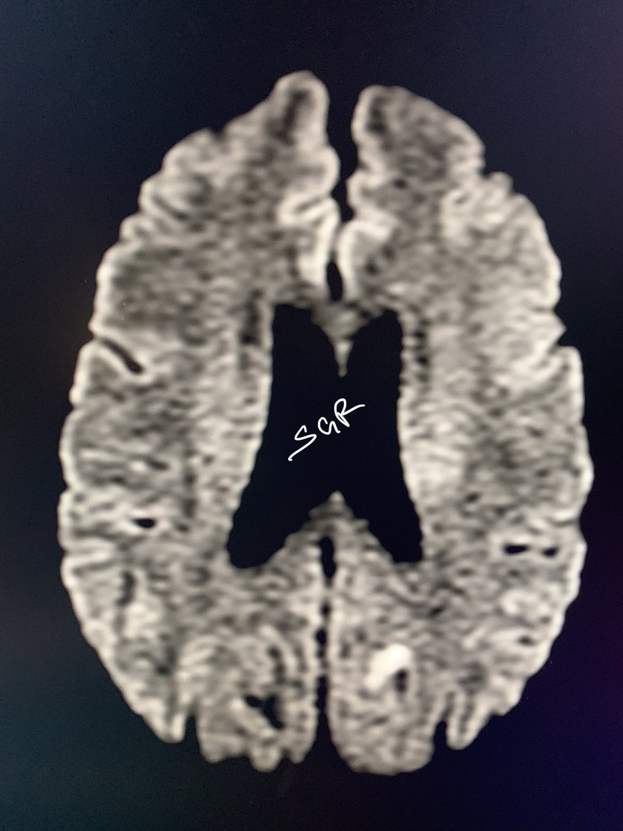 ChestradRoy's tweet photo. Saving the brain! #stroke #Neurology #CTperfusion showing CBV and CBF mismatch. Patient was thrombolysed.
#MRI the next day showing very small infarct on DWI and FLAIR.
#neurorad #MedTwitter #radtwitter #FOAMed https://t.co/0T7eZXMzBS