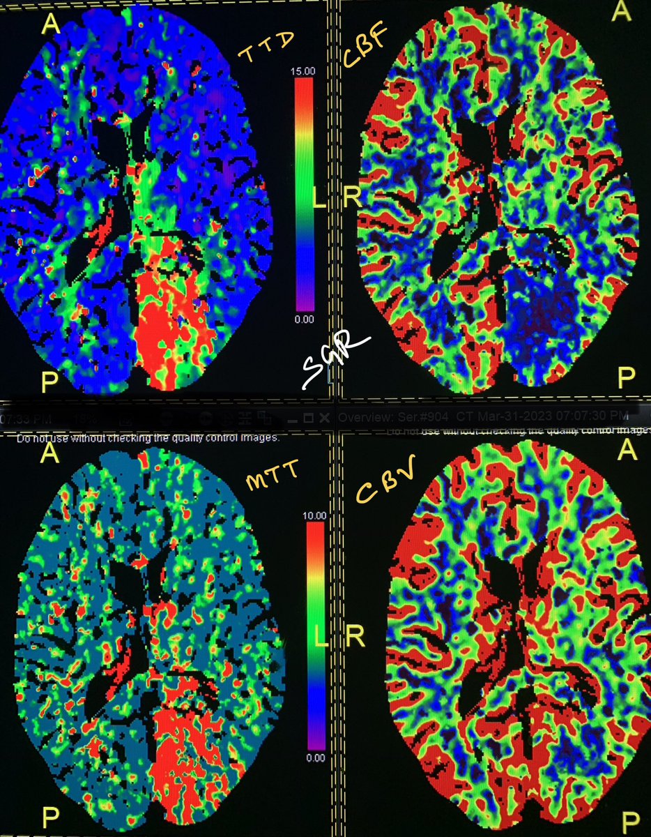ChestradRoy's tweet photo. Saving the brain! #stroke #Neurology #CTperfusion showing CBV and CBF mismatch. Patient was thrombolysed.
#MRI the next day showing very small infarct on DWI and FLAIR.
#neurorad #MedTwitter #radtwitter #FOAMed https://t.co/0T7eZXMzBS