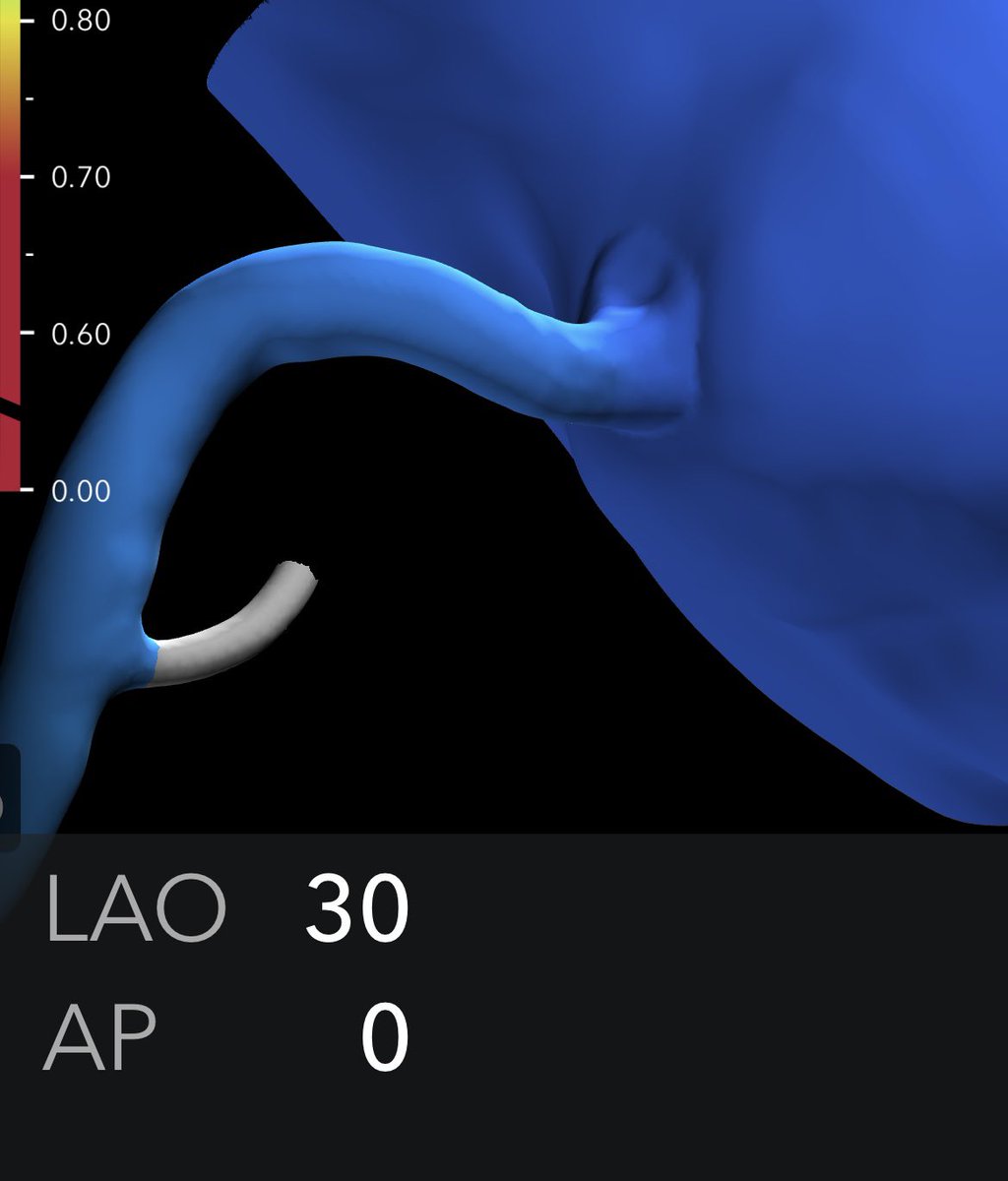 @SyedYNaqvi1 #Heartflow app for iPhone is great for playing w/ angles (see my screenshots) ➡️ For RCA ostium, steeper LAO is key, cranial less important. The paper below agrees, but these angles are hard to achieve & IQ definitely suffers doi.org/10.1016/j.jcin…