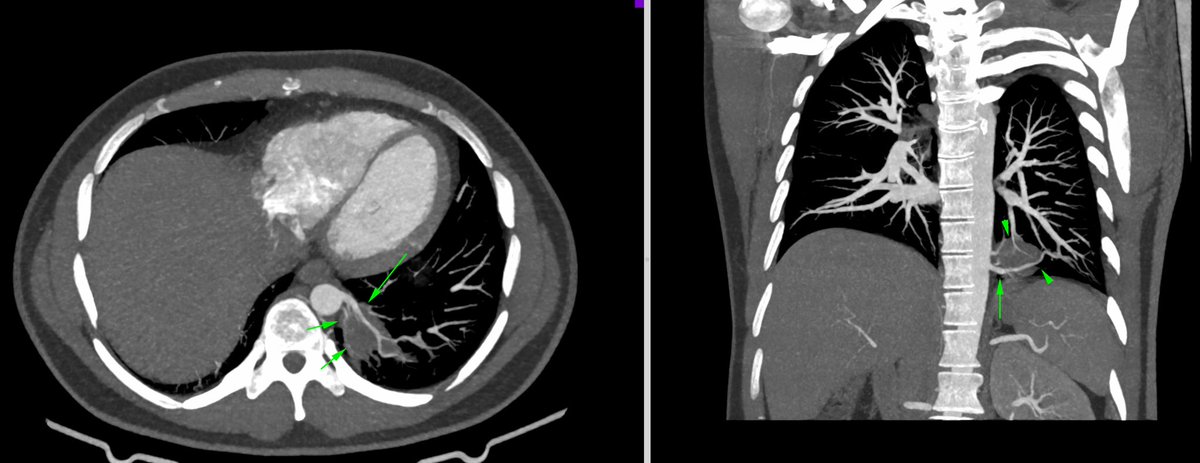 classic case of intralobar lung sequestration
#radiology #ct #lung #surgery @radiology_rsna @radiology_rsna @RadiologySigns #Ukraina