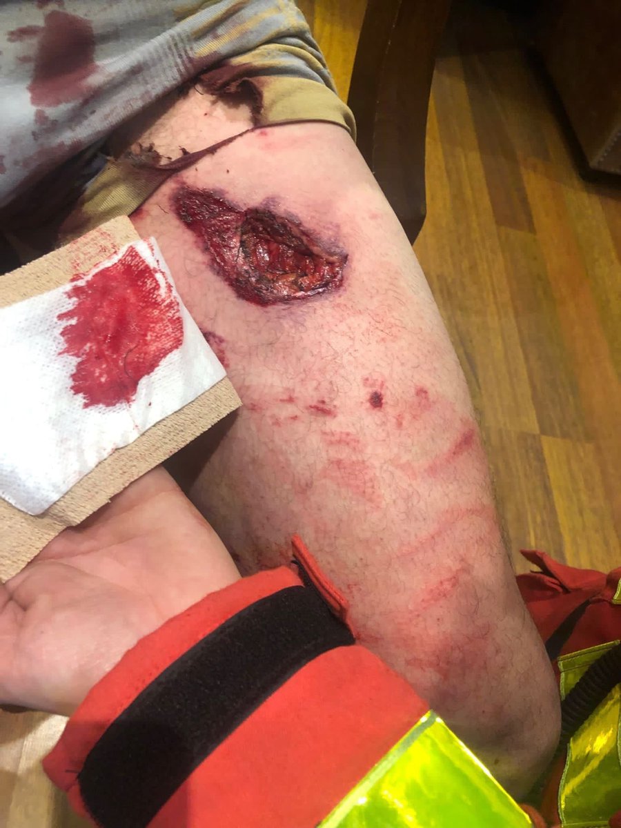 LindaKebbab's tweet photo. Pendant que certains dont des députés se plaignent de la réponse des policiers/ gendarmes hier, que d’autres trouvent les équipements de protection disproportionnés, voici la jambe (malgré la jambière) d’un gendarme après l’explosion d’une bombe agricole. Une BOMBE. @LDH_Fr ? https://t.co/P37d6k0To6